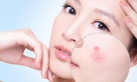 Kem Trị Mụn Hiệu Quả Kayoko Nhật Bản